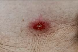 Cụ bà 88 tuổi nhiễm trùng toàn thân vì sốt mò từ vết đốt nhỏ