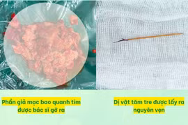 Bé trai nguy kịch vì tràn mủ màng tim, bác sĩ phát hiện tăm tre xuyên thất phải