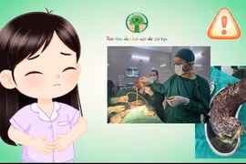 Bé 5 tuổi bị búi tóc lớn trong dạ dày do hội chứng Rapunzel
