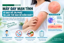Mày đay kéo dài trên 6 tuần: Cẩn trọng tự chữa, kiêng khem quá mức