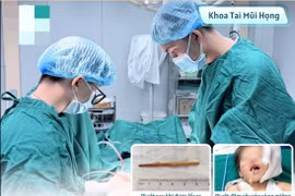 Ngậm đũa khi chơi, bé 2 tuổi suýt thủng sọ não