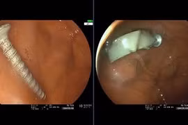 Bé gái 11 tháng tuổi suy hô hấp vì nuốt đinh vít dài 4 cm vào dạ dày