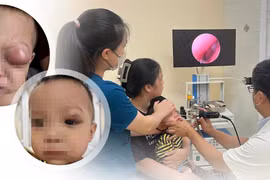 Mắt trẻ sưng đỏ, lồi lên vì viêm xoang: Cảnh giác nguy cơ mất thị lực