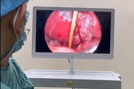 Sau 3 tuần nuốt tăm tre, bé trai 8 tuổi bị dị vật đâm xuyên tá tràng vào gan