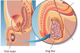 Phương pháp điều trị ung thư tinh hoàn mới, tiên lượng tích cực