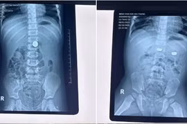 Nhiều trẻ nhập viện vì nuốt dị vật trong 2 ngày liên tiếp tại Hải Phòng