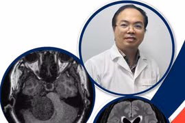 Mổ lấy thai bóc tách u não thành công cho sản phụ mang thai lần 5