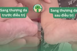 Bong tróc da tay, chân, bé 3 tháng tuổi phải điều trị giang mai do lây từ mẹ