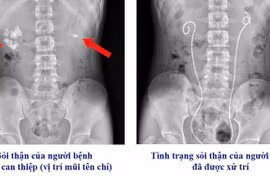 Đau thắt lưng, thiếu niên 16 tuổi suy thận cấp vì sỏi thận, niệu quản 