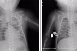 Cứu sống trẻ sơ sinh 1 ngày tuổi suy hô hấp nguy kịch do thiếu surfactant