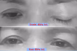 Phục hồi sụp mi mắt, nhìn đôi sau tai nạn do liệt dây thần kinh III