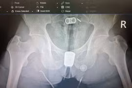 Dị vật trực tràng mắc sâu phải mổ mở để xử lý thành công
