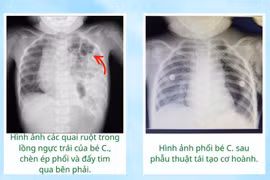 Ho kéo dài, bé gái 17 tháng tuổi phát hiện thoát vị hoành hiếm gặp