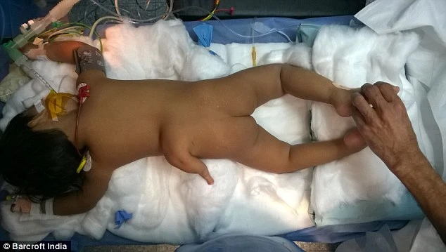 Kỳ lạ em bé sinh ra đã có 3 chân