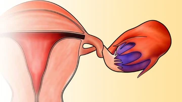 Xoắn phần phụ, cấp cứu phụ khoa nguy hiểm cần phát hiện sớm