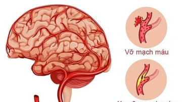 Báo động đột quỵ não gia tăng nhanh ở người trẻ tuổi