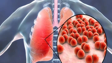 Cảnh báo mức độ nguy hiểm của nhiễm nấm phổi