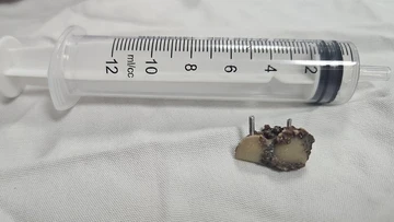 Gắp thành công 2 chiếc răng giả bỏ quên trong phổi bệnh nhân hơn 20 năm 