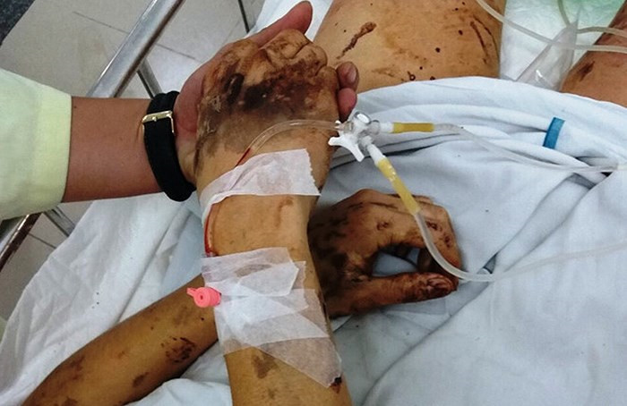 Sau đó, kẻ lạ mặt rút dao chém vào khớp gối và gân chân của anh Nghiêm trước khi lên xe tẩu thoát. Anh Nghiêm bị tạt axit bỏng 90% gương mặt, mắt không thể mở hoàn toàn và thị lực chỉ còn khoảng 15-20%.