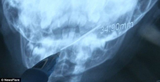Khi nhìn hình ảnh chụp X-quang, các bác sĩ phát hiện trong cổ họng bé là một thanh kim loại dài gần 4cm, một đầu đang mắc vào ami-đan còn đầu kia ở vị trí đáy cổ họng.