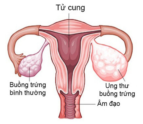 Mặc dù bác sĩ sản khoa khuyến cáo phụ nữ không nên thụt rửa vùng kín nhưng rất nhiều phụ nữ vẫn thực hiện thói quen xấu này vì hiểu lầm rằng càng thụt rửa thì vùng kín sẽ càng sạch sẽ hơn. Trong số những người tham gia nghiên cứu nói trên có 154 trường hợp bị ung thư buồng trứng và kết quả cho thấy những người từng vệ sinh vùng kín không đúng cách như trên có nguy cơ ung thư cao gấp đôi.