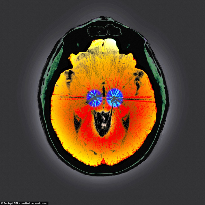 Đây là não của một bệnh nhân bị bệnh Parkinson. Hai cực điện của thiết bị kích thích não đã được cấy vào não để điều hòa nhịp tim. Thiết bị này gửi tín hiệu xung điện đến các vùng não màu xanh để cải thiện những triệu chứng của bệnh này.