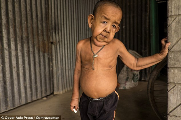 Bé Bayezid Hossain sống ở ngoại ô Magura phía Nam Bangladesh mang một khuôn mặt chảy xệ, mắt sâu hõm, da nhăn nheo, khớp chân tay đau nhức, khó đi tiểu, răng yếu thậm chí đã rụng mặc dù mới chỉ 4 tuổi.