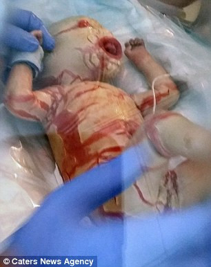 Khi còn trong bụng mẹ, tế bào da của bé phát triển nhiều tới mức máu không lưu thông được tới chân và tay. Lúc mới sinh ra, bé Harper trông giống như người ngoài hành tinh, toàn thân phủ đầy một lớp da bong tróc, chân tím bầm. Mặc dù các bác sĩ đã gỡ bỏ được các mảng bám và chuyển sang khoa chăm sóc đặc biệt ngay sau khi sinh, nhưng bé Harper vẫn bị mất 4 đầu ngón tay phải.