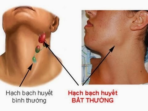 Đối với những người từ bỏ thuốc lá thì sau 5 năm những biến đổi ADN này sẽ quay trở lại như bình thường. Chỉ có điều 19 gien đã bị biến đổi, trong đó có gien TIAM2 gây ung thư bạch huyết giữ nguyên trạng thái như vậy trong suốt 30 năm.