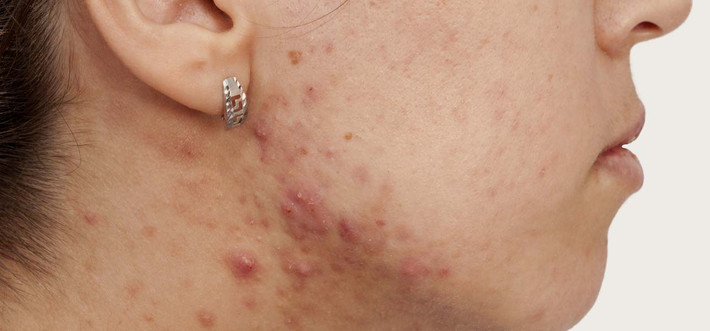 Nếu da trong tình trạng bị đỏ hoặc bị trứng cá đỏ, hãy thử resveratrol, một chất chống oxy hóa có trong rượu vang đỏ với đặc tính kháng viêm, một sự lựa chọn lý tưởng cho những người bị eczema, trứng cá đỏ hoặc mụn.