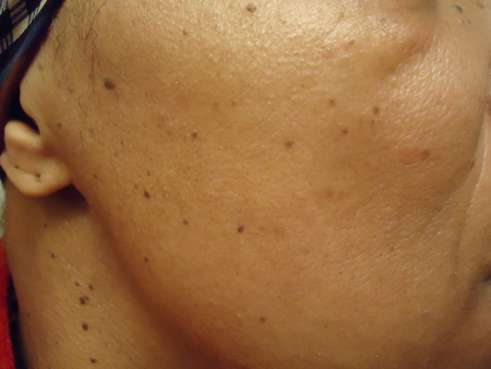 Đối với những làn da có đốm nâu nên làm bạn với các loại serum có vitamin C vì vitamin C phá vỡ sự sản sinh hắc tố melanin khiến da sẫm màu. Tuy nhiên cần lưu ý tìm những chai có màu tối vì vitamin C rất không ổn định khi tiếp xúc với không khí và ánh nắng mặt trời.