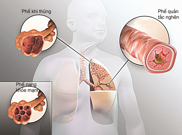 Một số bệnh ở phổi như phổi tắc nghẽn mãn tính cũng làm tăng nguy cơ ung thư phổi lên gấp 5-6 lần sau khi đã loại bỏ nguyên nhân đồng phát từ hút thuốc lá.