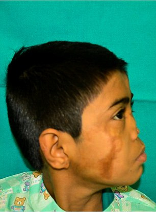 Hiện Arun vẫn được các bác sĩ theo dõi chặt chẽ đề phòng trường hợp cần phẫu thuật thêm. Toàn bộ chi phí phẫu thuật được miễn phí vì gia cảnh Arun cũng rất khó khăn.