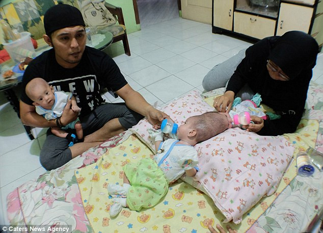 Cặp chị em song sinh Nadira Alifa Putri và Nadiba Aisyah Putri được sinh ra trong một ca mổ sinh ba tại một bênh viện ở Indonesia. May mắn cho gia đình là một trong số 3 chị em được sinh ra như một đứa trẻ bình thường, và cũng không may cho Nadira và Nadiba khi hai chị em bị dính liền hộp sọ.
