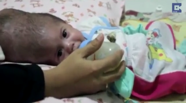 Tuy nhiên việc mổ tách rời hai bé bị dính liền hộp sọ hiện nay là rất khó khăn vì các bé vẫn còn quá nhỏ. Để có thể sống sót được sau ca phẫu thuật, mỗi bé cần cân nặng ít nhất 10kg. Trường hợp đặc biệt này đã được chuyển lên một bệnh viện trung ương của Indonesia nhưng vì đây là ca mổ phức tạp đòi hỏi độ chính xác và tay nghề cao nên cha mẹ của hai bé vẫn cần phải đợi thêm ít nhất từ 6-8 tháng nữa cho đến khi hai bé đủ trọng lượng vì đây là một quyết định không thể xem thường.