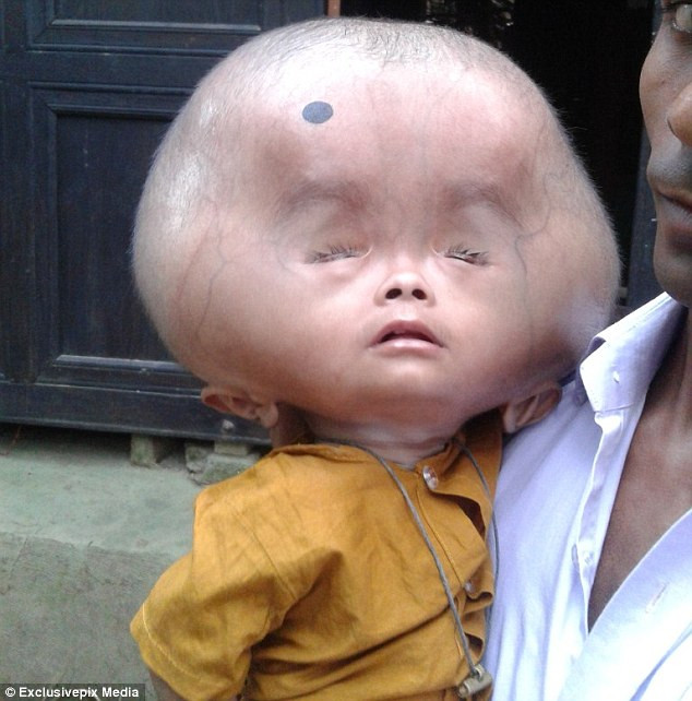 Một bé trai hai tuổi tên Emon tại Bangladesh có phần đầu khổng lồ nặng tới 9kg – tương đương với cân nặng trung bình của em bé một tuổi.