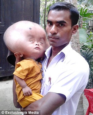 Tuyệt vọng vì tình trạng của con trai, bố mẹ bé đã lo lắng tìm kiếm thầy thuốc và bác sĩ ở các làng bên nhưng vì trình độ y tế lạc hậu nên không ai có thể chẩn đoán bệnh của bé. Họ thậm chí còn làm lễ cầu khấn thần linh để bé Emon khỏi bệnh nhưng không có kết quả, trong lúc đó thì đầu của bé Emon càng ngày càng to hơn.
