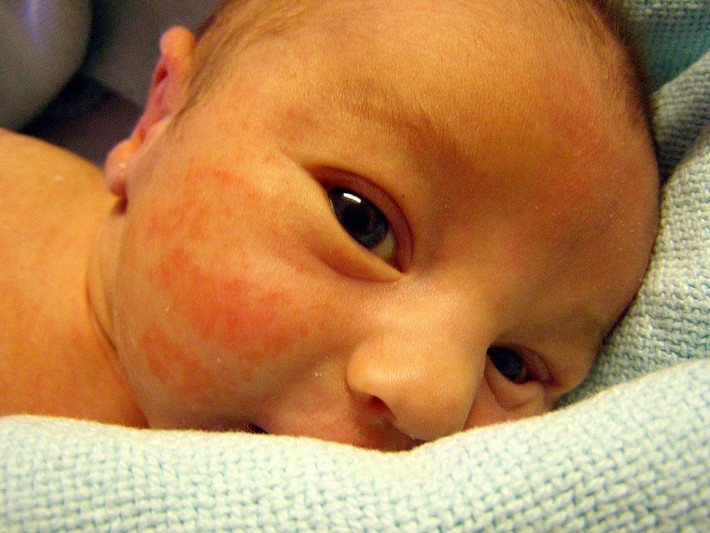 Nếu bé đang phải chống chọi với bệnh chàm bội nhiễm (eczema), hãy dùng dầu dừa thay vì các loại thuốc chứa steroid. Dầu dừa có tác dụng chống viêm sưng nên làm bé đỡ khó chịu.