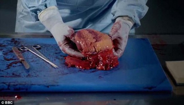 Thận người luôn được bọc trong một lớp mỡ bảo vệ nhưng ở người này, lớp mỡ xung quanh thận dày hơn rất nhiều và còn bị rỗ, một dấu hiệu khác của bệnh cao huyết áp.