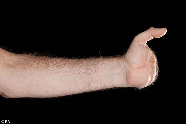 Nhớ lại khoảng thời gian phải thích nghi với cuộc sống mới sau tai nạn không có bàn tay, ông cho biết khi trở lại nơi làm việc có chiếc máy ép đã cán nát 2 bàn tay, ông cũng không hề có cảm giác ghê sợ. Thậm chí ông còn cải tiến chiếc xe đạp để có thể duy trì thói quen đạp xe.