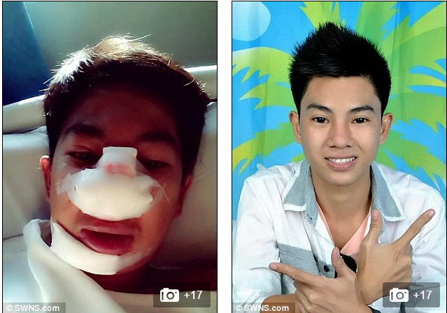 Nhưng sau đó chỉ vài tuần vùng phẫu thuật bị viêm và khi mổ lại bác sĩ mới phát hiện ra bên trong mũi là một hỗn hợp “cocktail” cực độc gồm wax, vaselin và keo dán.