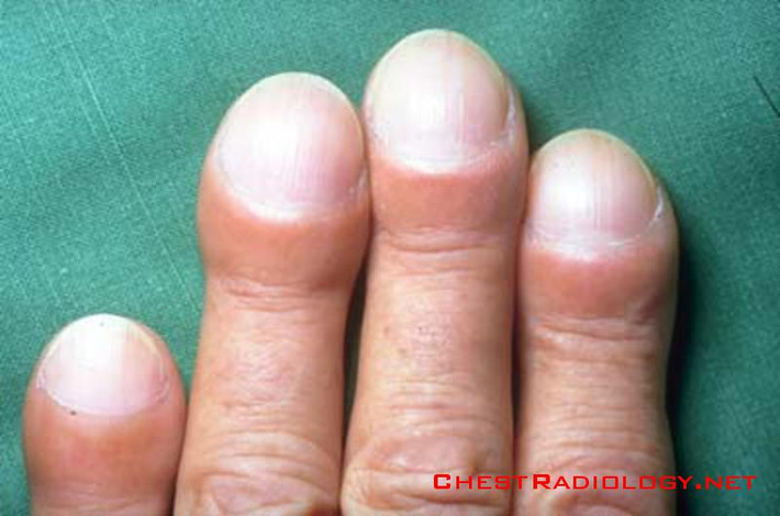 Đôi khi nếu bạn cảm thấy đau và đỏ ở đầu ngón tay hay móng tay cũng có thể là dấu hiệu của ung thư phổi. Tuy nhiên dấu hiệu này cũng có thể nhầm lẫn với dấu hiệu của bệnh viêm khớp.