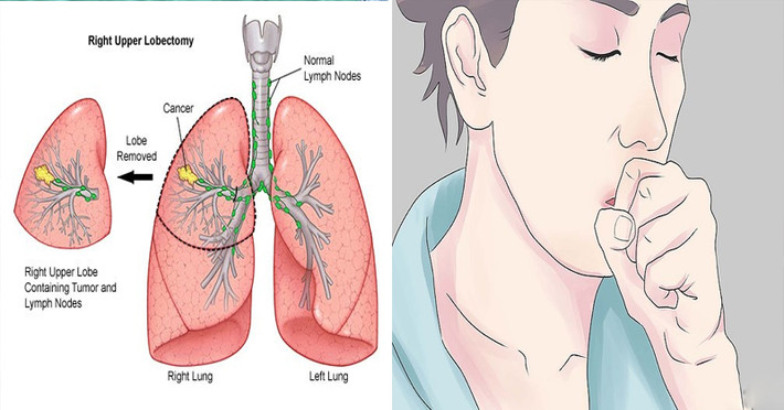 Nếu bạn thấy giọng nói của mình khàn khàn như vịt, đặc biệt là khi kèm theo ho kéo dài thì đó có thể là một dấu hiệu xấu của bệnh phổi.
