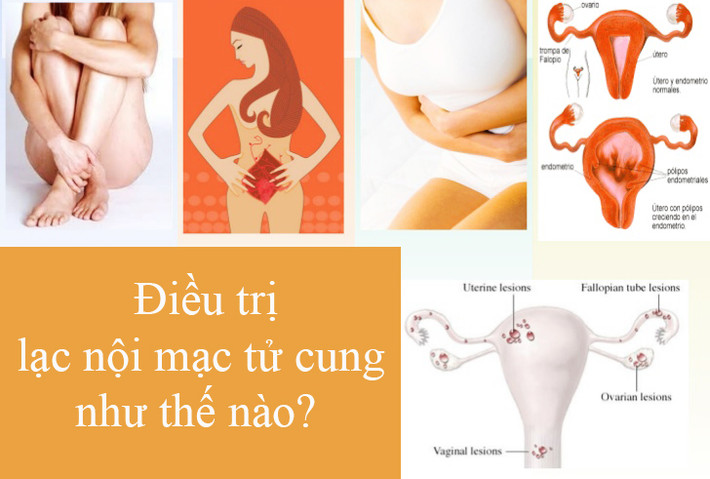 Lạc nội mạc tử cung là bệnh các mô nội mạc phát triển ra ngoài tử cung, dấu hiệu chủ yếu là đau khung xương chậu và vô sinh. Khoảng 6-10% phụ nữ mắc căn bệnh khó chữa này nhưng ít người nói ra. Bệnh thường gặp ở lứa tuổi 30-40 nhưng trẻ em khoảng 8-9 tuổi cũng có thể mắc như trường hợp nói trên. Nguyên nhân căn bệnh khó chữa này không thực sự rõ ràng nhưng tiền sử gia đình cũng là một yếu tố khá quan trọng.