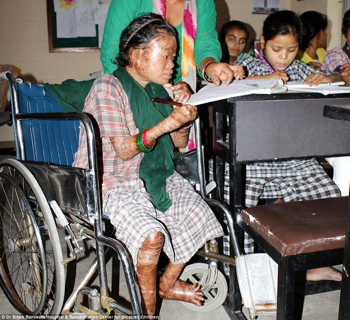 Bệnh này hiện nay vẫn chưa có thuốc chữa. Người bị bệnh nặng luôn phải mất vài tiếng mỗi ngày chăm sóc da bằng các loại kem dưỡng ẩm như vaseline để da mềm hơn. Mặc dù đây là loại kem rất rẻ tiền nhưng gia đình Nagina cũng không có điều kiện để mua.