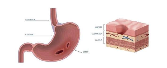 Loét dạ dày là do nhiễm trùng từ vi khuẩn H.plyori: Nó xảy ra khi axit thâm nhập sâu vào niêm mạc dạ dày của bạn, gây ra một vết loét mở. Điều này có thể dẫn đến đau dạ dày, đầy hơi, ợ nóng và buồn nôn.