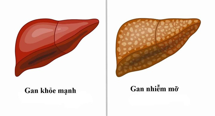 Bệnh gan nhiễm mỡ là một tình trạng gan gặp khó khăn trong việc phá vỡ chất béo, gây ra sự tích tụ mỡ trong mô gan. Trong giai đoạn đầu, bệnh gan nhiễm mỡ thường không gây ra bất kỳ triệu chứng đáng chú ý nào. Qua thời gian, chất béo tích lũy trong gan có thể gây viêm và sẹo.