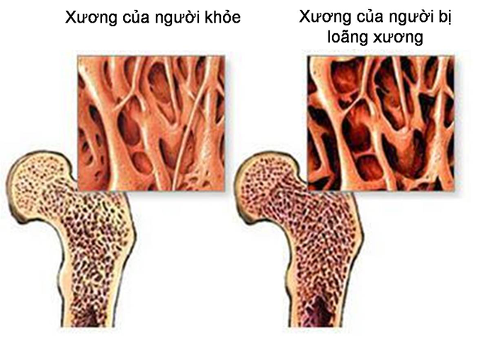 Loãng xương là một bệnh dẫn đến suy thoái xương, làm cho chúng trở nên mỏng và dễ vỡ. Nó cũng là một "căn bệnh thầm lặng" và thường không có triệu chứng trong giai đoạn đầu. Một vài dấu hiệu của chứng loãng xương khác là giảm chiều cao theo thời gian, đau lưng, bướu cổ và gãy xương ngay cả khi bị ngã nhẹ.