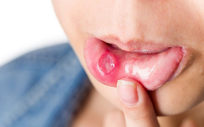 Lở miệng: Đây là một trong những tác dụng phụ phổ biến của hóa trị liệu cũng như xạ trị. Đôi khi nó có thể nghiêm trọng nếu lở loét miệng có thể cản trở bệnh nhân ăn uống. Khi không nhận được đủ chất dinh dưỡng, cơ thể sẽ suy kiệt và dẫn đến một loạt các vấn đề nghiêm trọng khác.