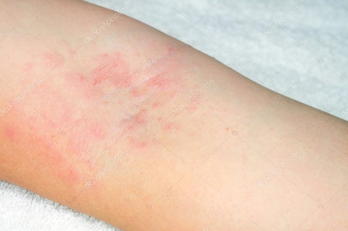 Làm hại da: Có khoảng 60 - 80% bệnh nhân bị nhiễm độc da sau khi điều trị ung thư bằng hóa trị. Những ảnh hưởng của phương pháp điều trị này là da khô, phát ban da, ngứa, viêm niêm mạc và lông mọc bất thường.